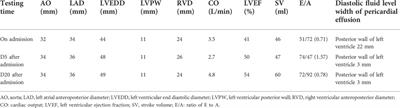 The therapeutic effect of glucocorticoids on type II respiratory failure, heart failure, and massive pericardial effusion caused by hypothyroidism: A case report